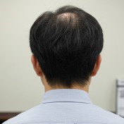 薄毛の状態