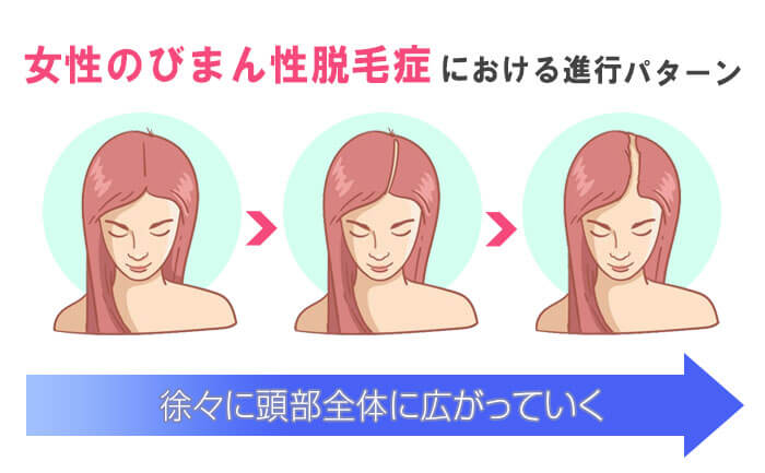びまん性脱毛症