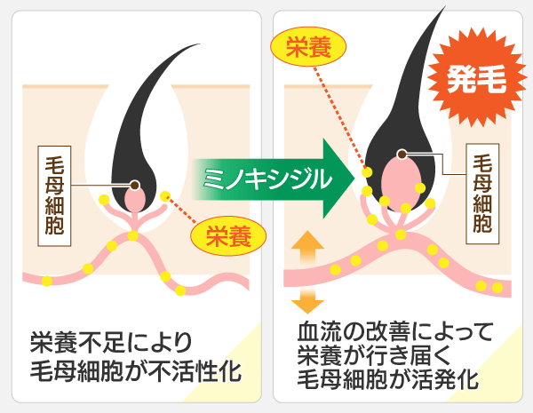 ロゲイン(女性用)